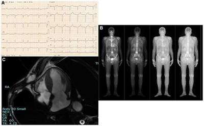 Case Report: A rare homozygous patient affected by TTR systemic amyloidosis with a prominent heart involvement